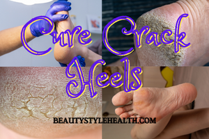 15 Home Remedies Of How To Cure Cracked Heels This Winter?
Prevention And Cure